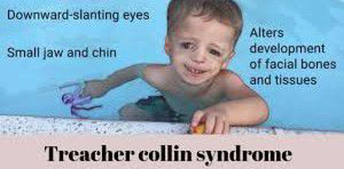 Symptoms of treacher Collins syndrome