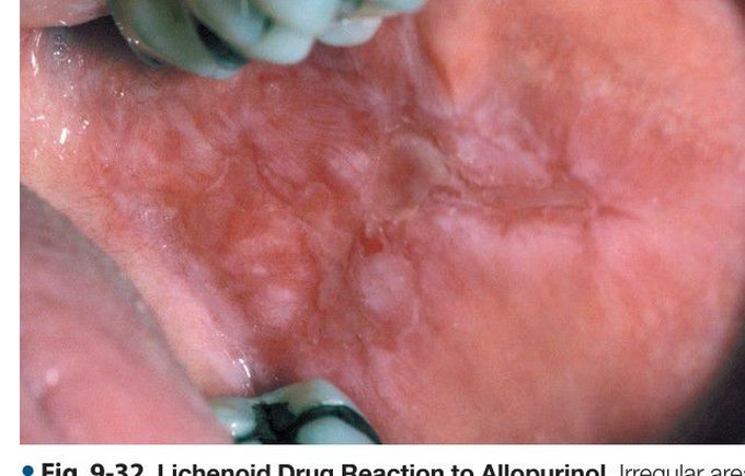 Lichenoid Drug Reaction to Allopurinol.