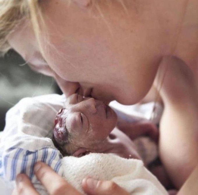 Anencephaly-a painful shot