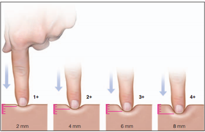 Grading of edema