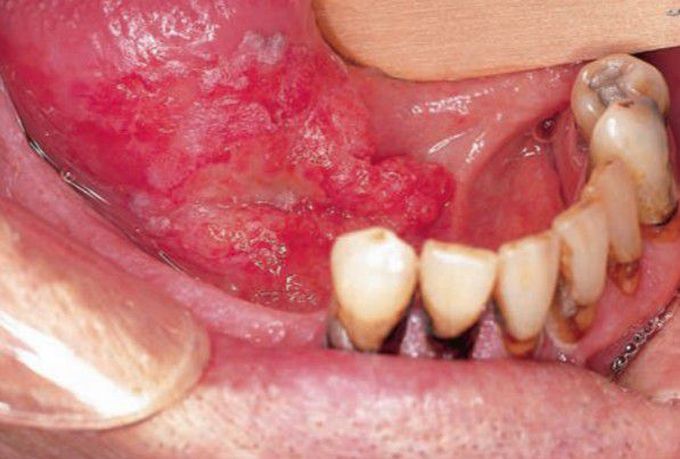 Squamous cell carcinoma of oral cavity