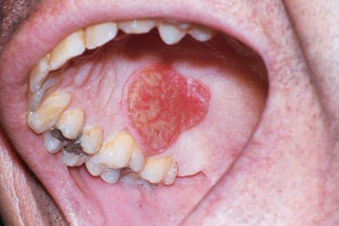 Squamous cell carcinoma of palate