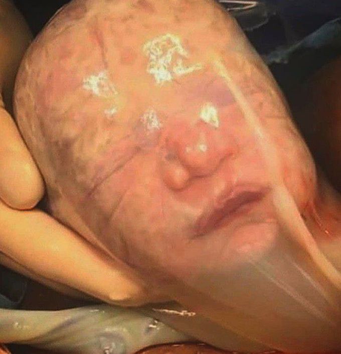 Baby born in Amniotic Sac!