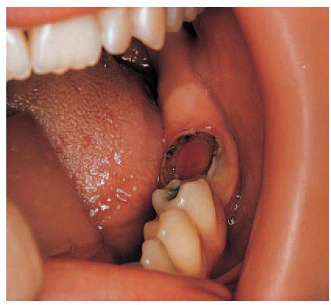 Pulp polyp.