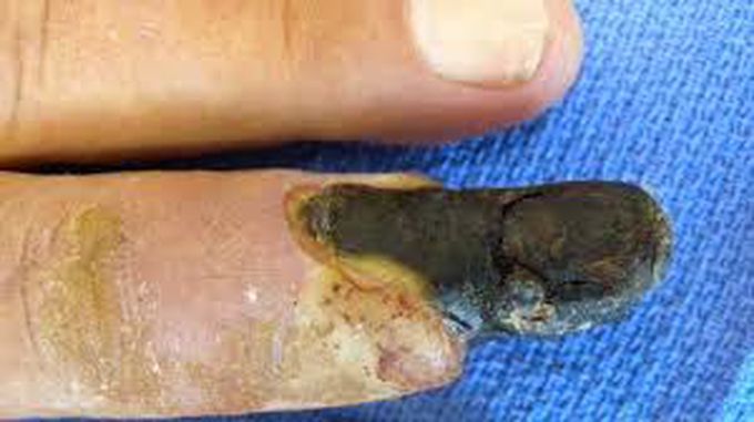 Warning signs of gangrene