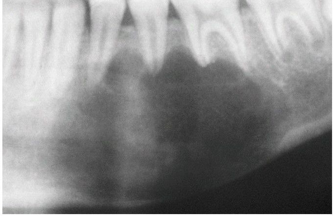 Simple Bone Cyst.