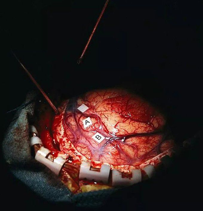 neurosurgery