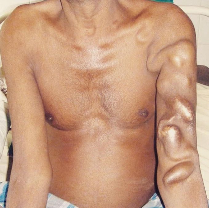 Renal Failure