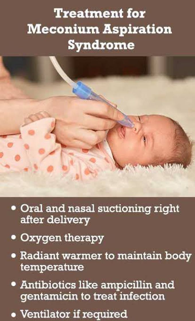 Treatment for the Meconium aspiration syndrome