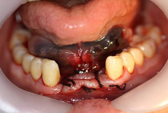 Risks of dental implant surgery