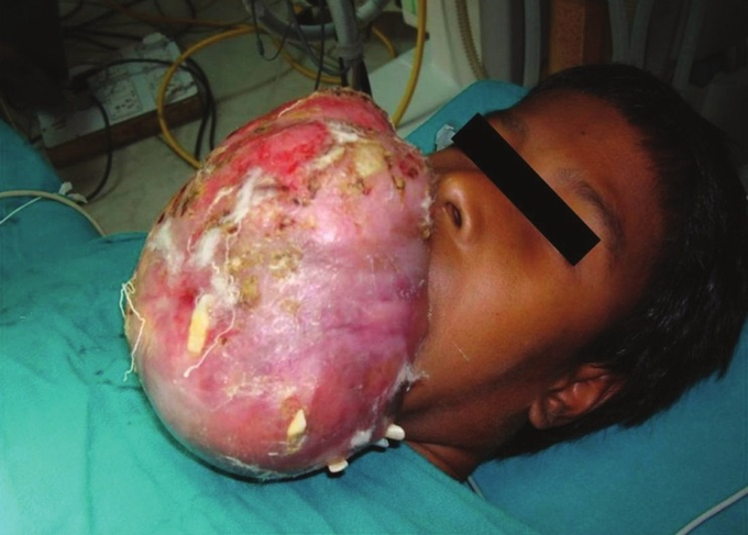 Massive Ossifying Fibroma In 10-Year-Old Boy With Sickle-Trait