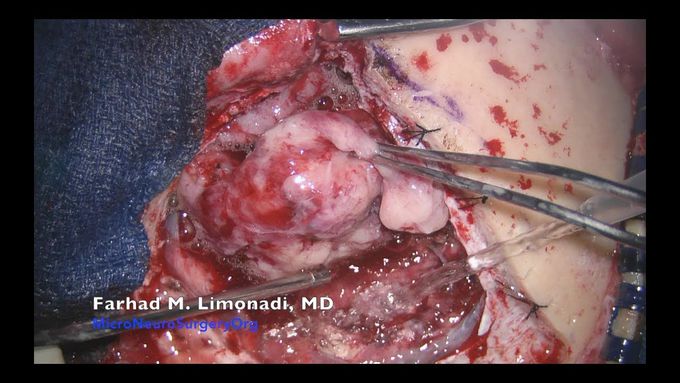 Brain Tumor Surgery: A man with large frontal brain tumor (meningioma)