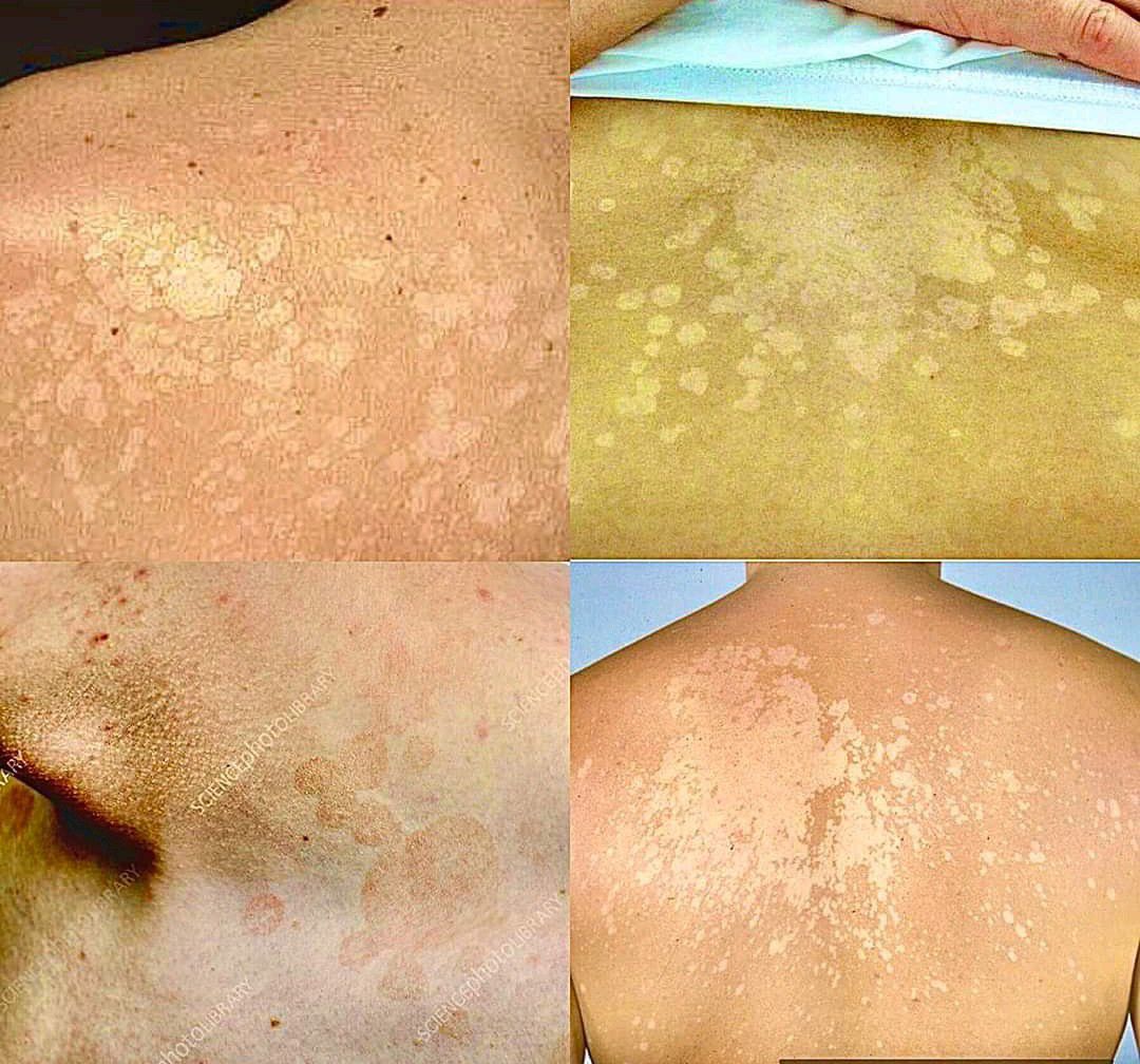 Tinea Versicolor MEDizzy