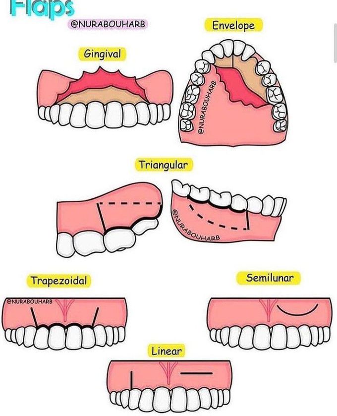 Types of flaps in oral surgery