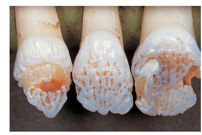Amelogenesis imperfecta