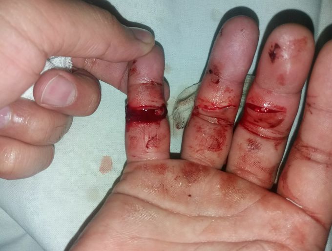 After trauma