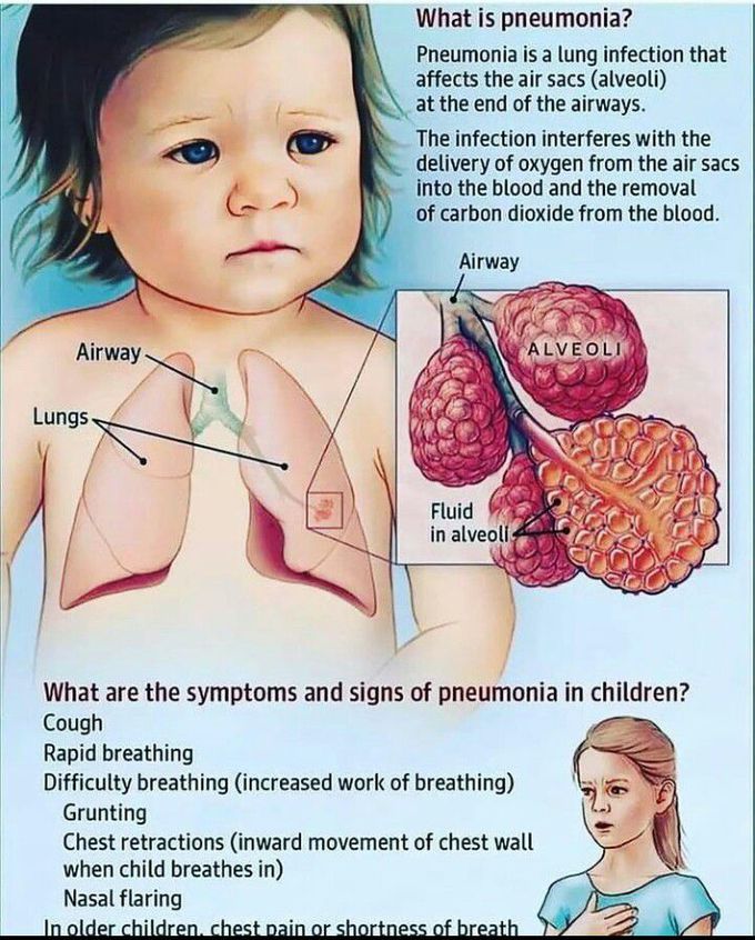 Pneumonia