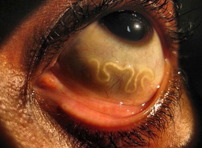 Eye worm or filariasis in 👁