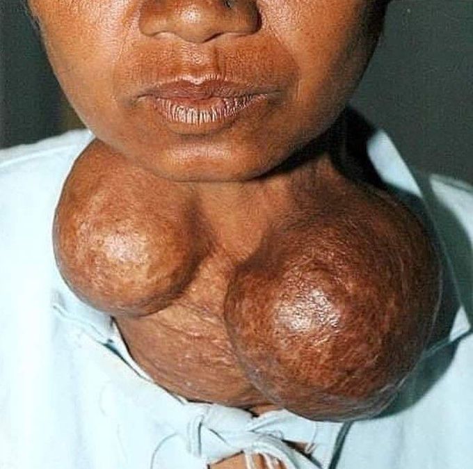 Goiter-(enlarged thyroid glands)