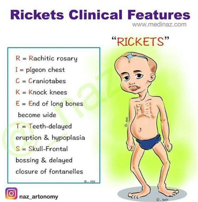 Rickets