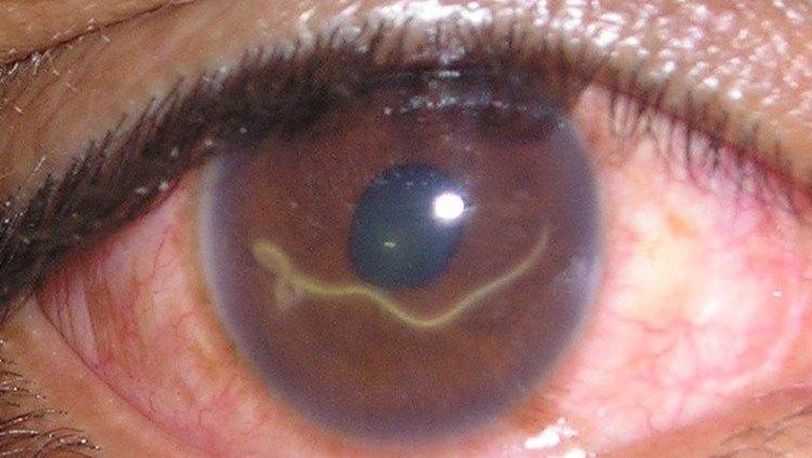 A Worm In The Eye Loa Loa MEDizzy