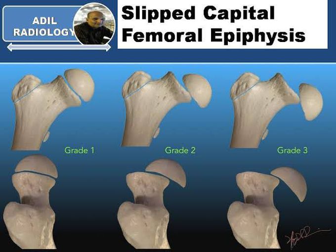 Grades of Slipped Capital Femoral Epiphysis