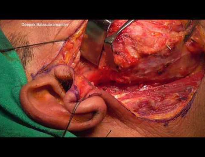 Superficial parotidectomy