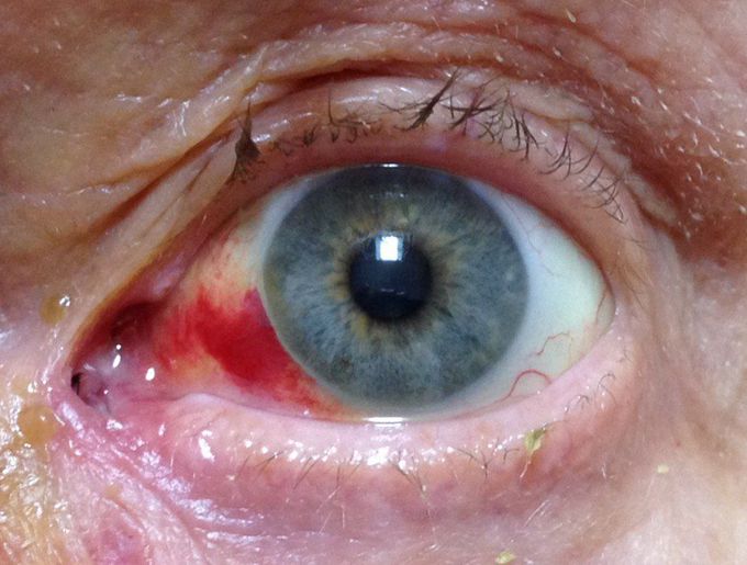 Subconjunctival haemorrhage: Post operative nasal subconjunctival haemorrhage in the left eye