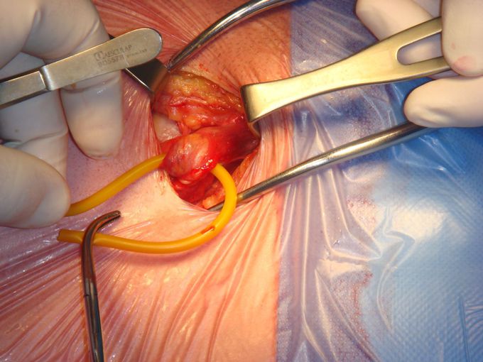 Treatment for Inguinal hernias