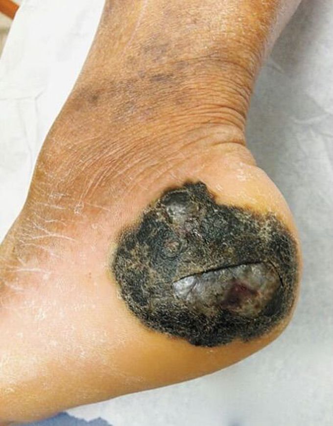 Which one of the following choices would be the least useful diagnostic test for this heel ulcer of 2 years' duration?

