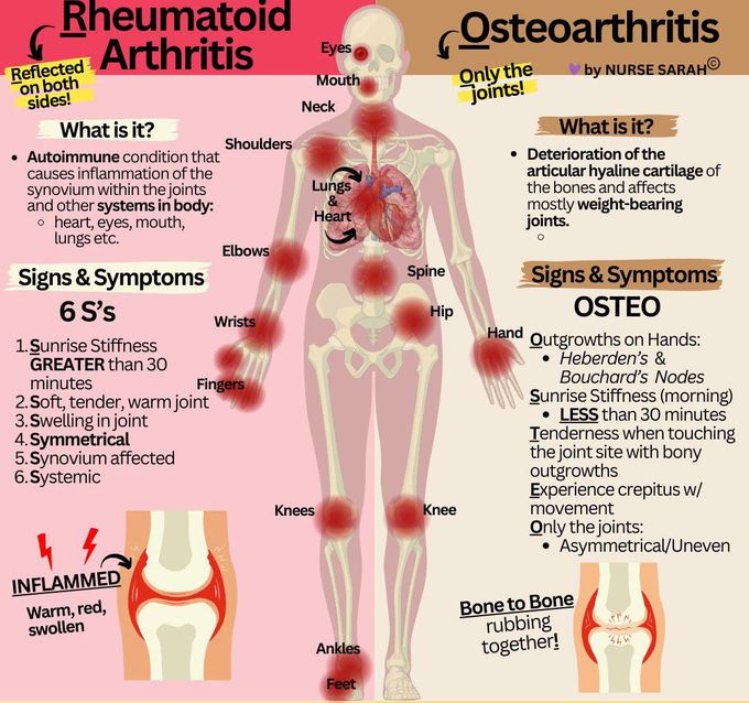 Rheumatoid Arthritis