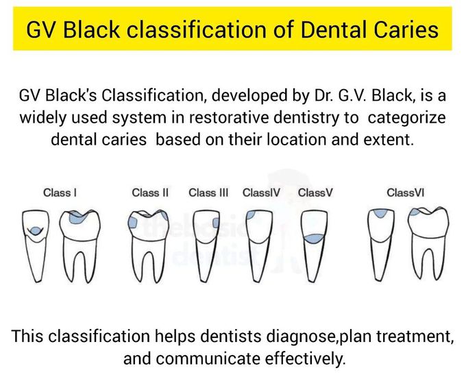 GV Black Classification of Dental Caries