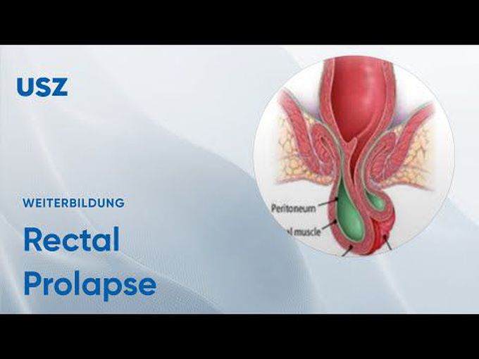Rectal Prolapse: Surgical Overview