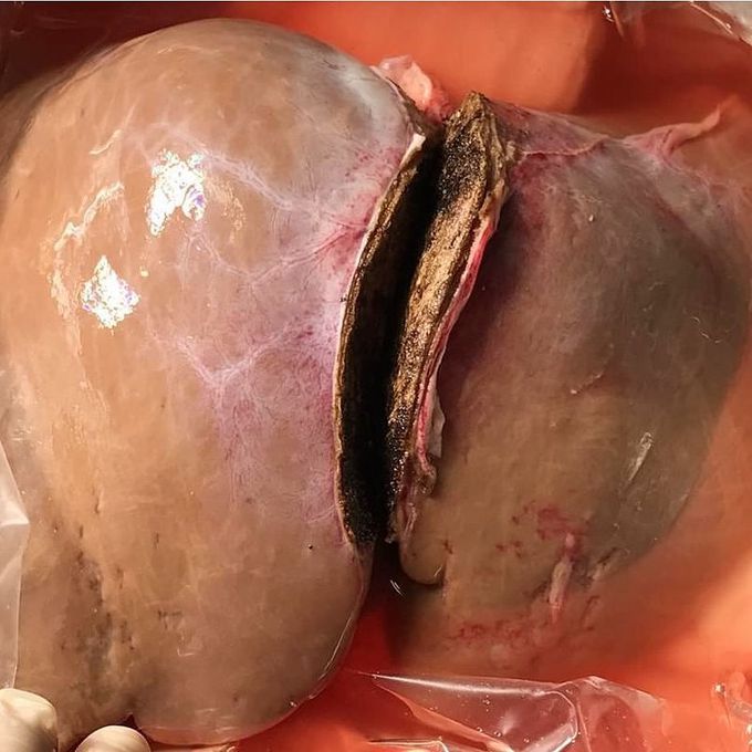 An amazing and life saving procedure - a split liver transplant on a pediatric patient!