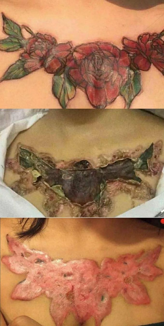 Unsuccessful in tattoo removal The 21-year-old girl decided to remove the flower she had tattooed on her chest. She decided to use a chemical method on her skin, but after a few days she started itching and severe pain. 🤷‍♂️