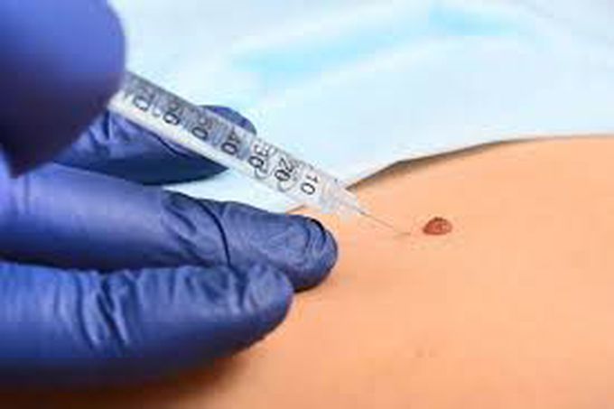 Local anesthesia