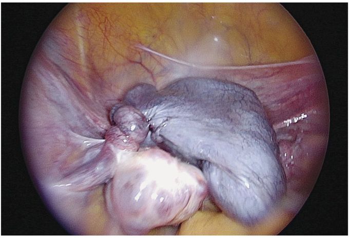 Fallopian Tube Torsion