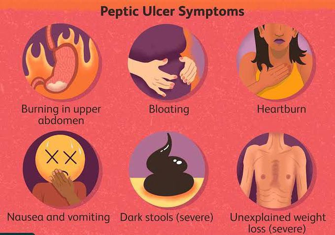 Peptic ulcer symptoms.