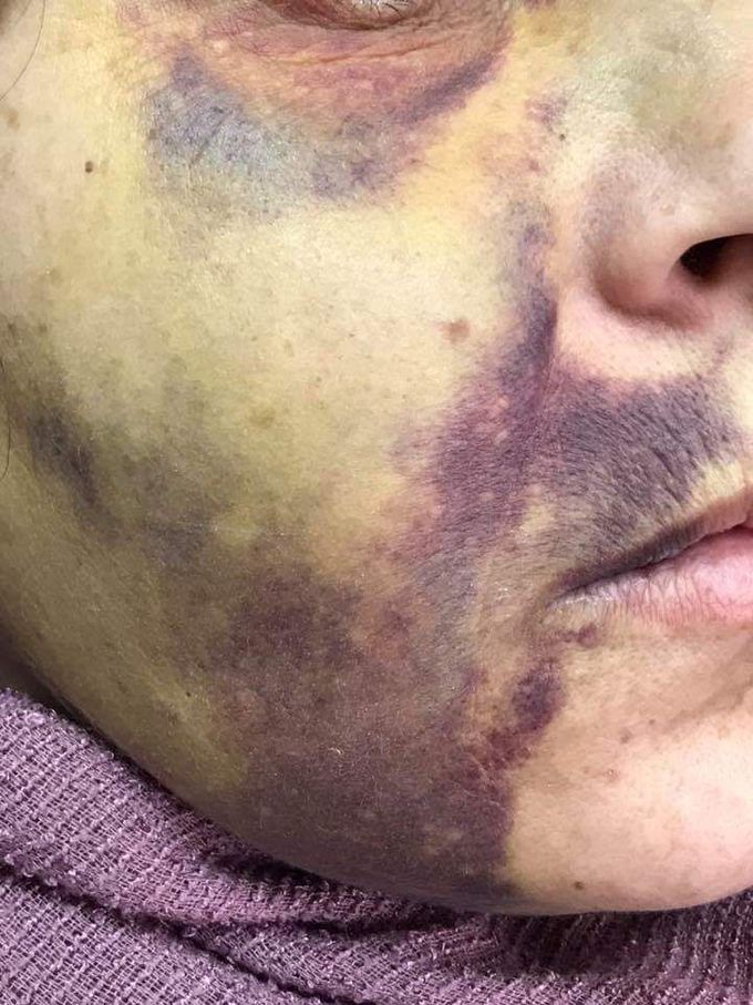 Hematoma of pterygoid plexus