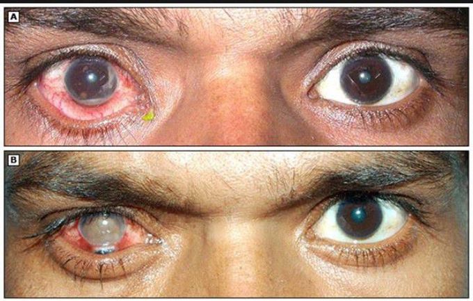 Eye tuberculosis symptoms