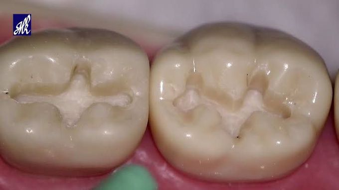 Class 1 cavity