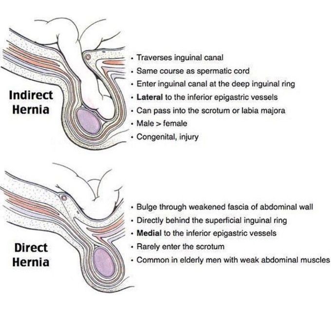 indirect-vs-direct-hernia-medizzy