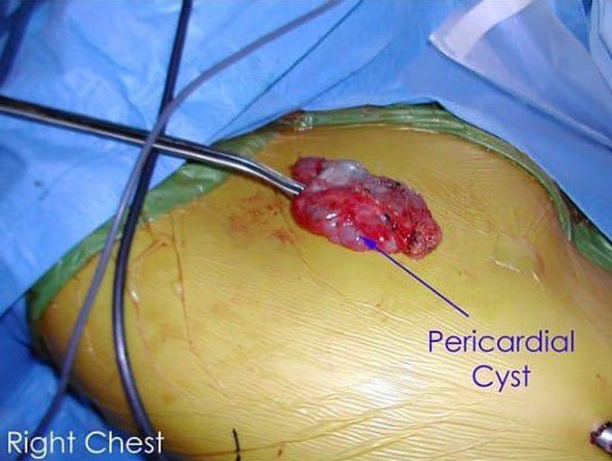 Pericardial cyst