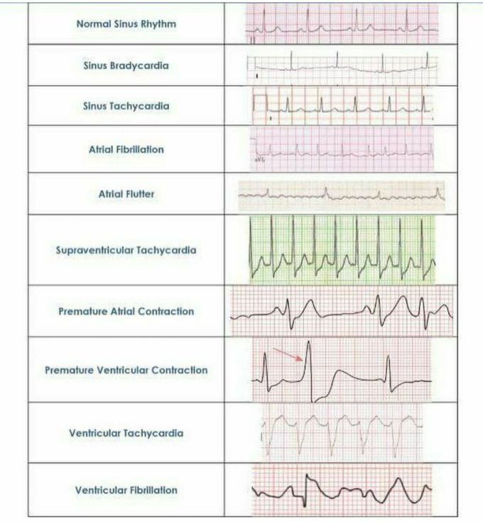 Ecg