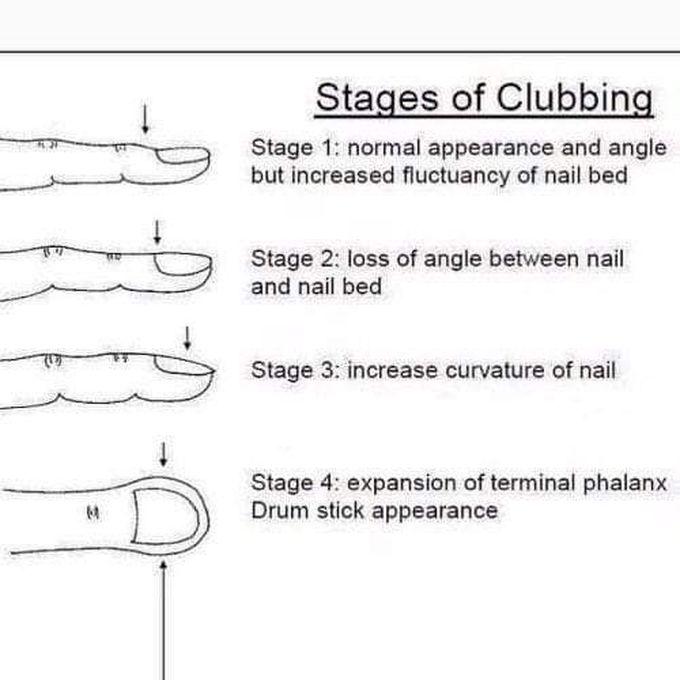 Clubbing