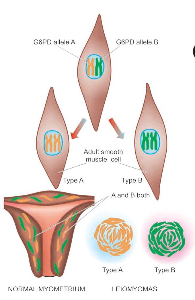 Leiomyoma