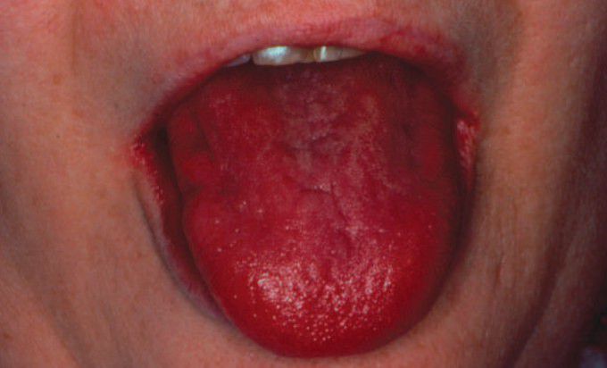 Atrophic candidiasis