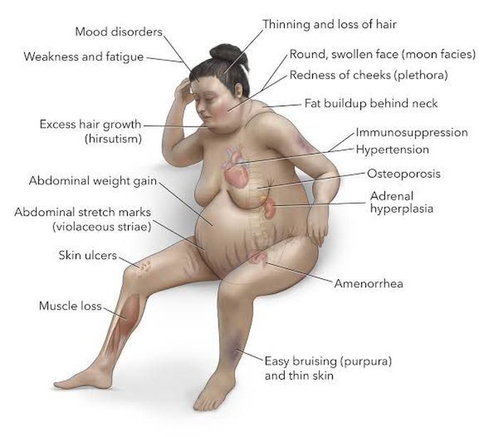 Cushing Syndrome Feature