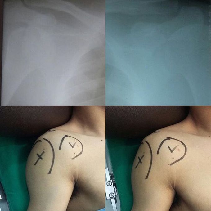 Dislocation is the complete displacement of articular surfaces