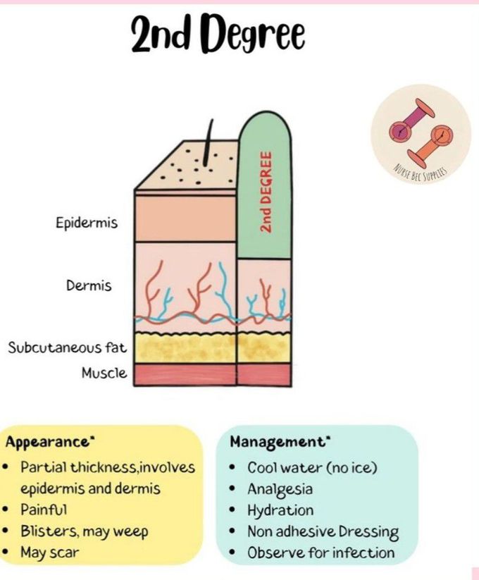 2nd Degree Burn